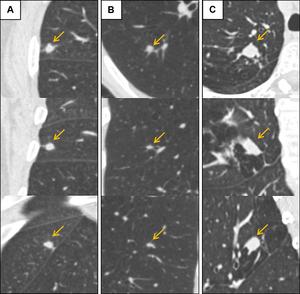 Low-dose CT images show examples of screen-detected pulmonary nodules