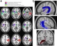 Brain Scans in PWS
