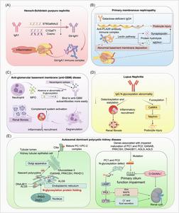 Aberrant Glycosylation Drives Kidney Disease Pathogenesis.