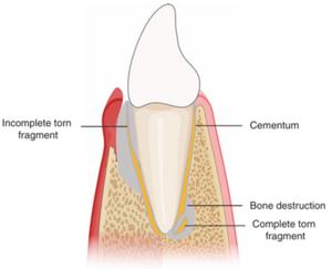Illustration of Cemental Tear in a Tooth Root