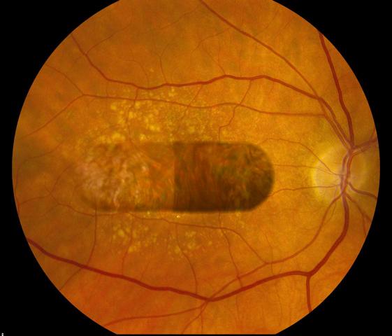 The AMD Eye