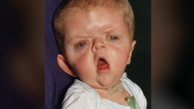 Apert Syndrome Research