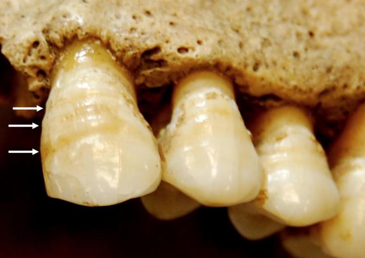 Linear Enamel Hypoplasia