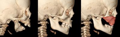 3-D CT Scan of Child with ACS
