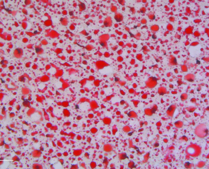 Liver Cancer