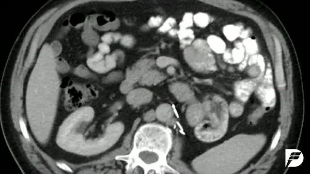 Drug Combination May Become New Standard Treatment for Advanced Kidney Cancer