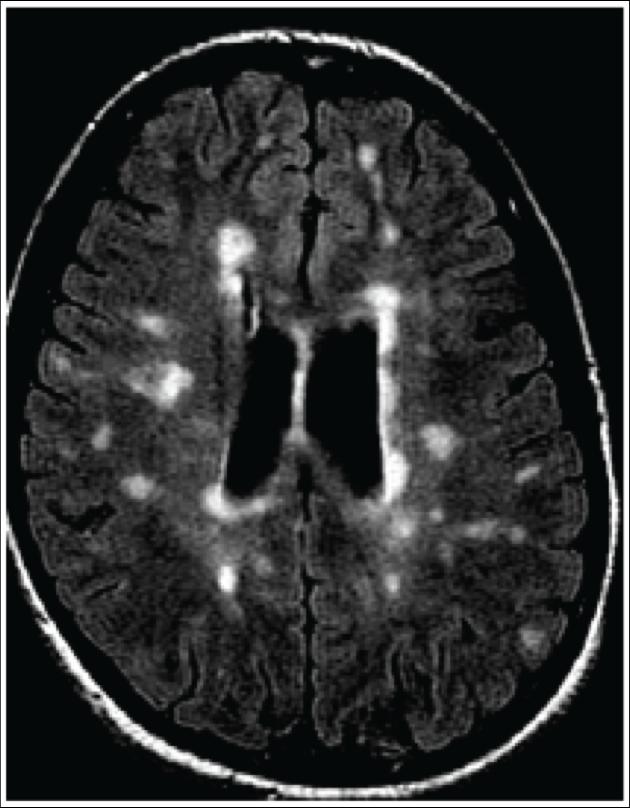 Multiple Sclerosis Scarring of Brain