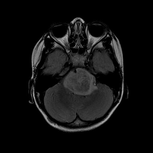 Slowing Down Deadly Brain Cancers