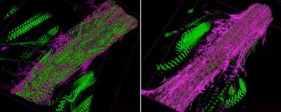 Fibrotic Fly Heart