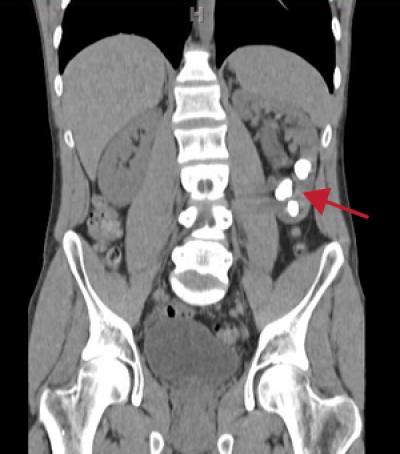 Kidney Stone Mystery Solved