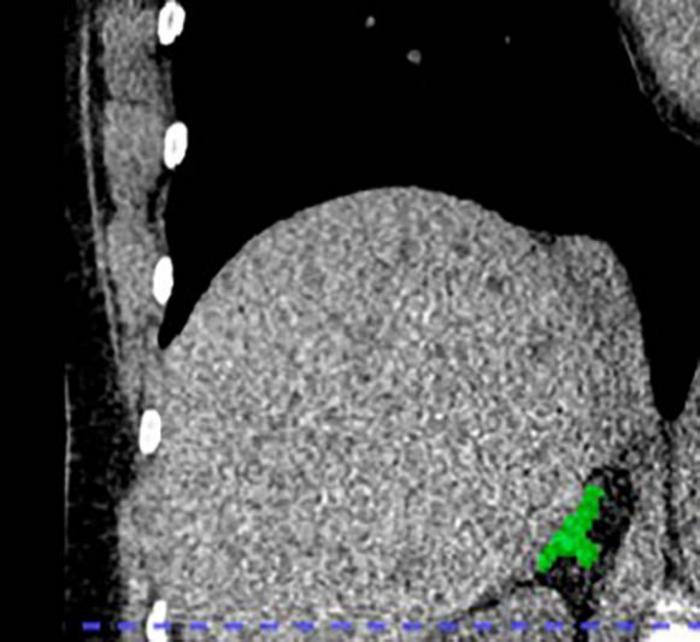 Right adrenal automated 2D segmentation in chest CT.