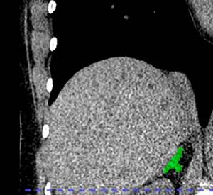 Right adrenal automated 2D segmentation in chest CT.