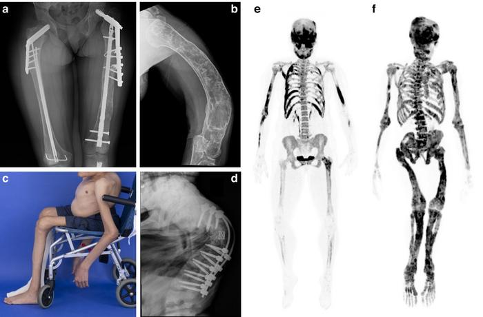 Severe skeletal deformities and disease burden in fibrous dysplasia patients