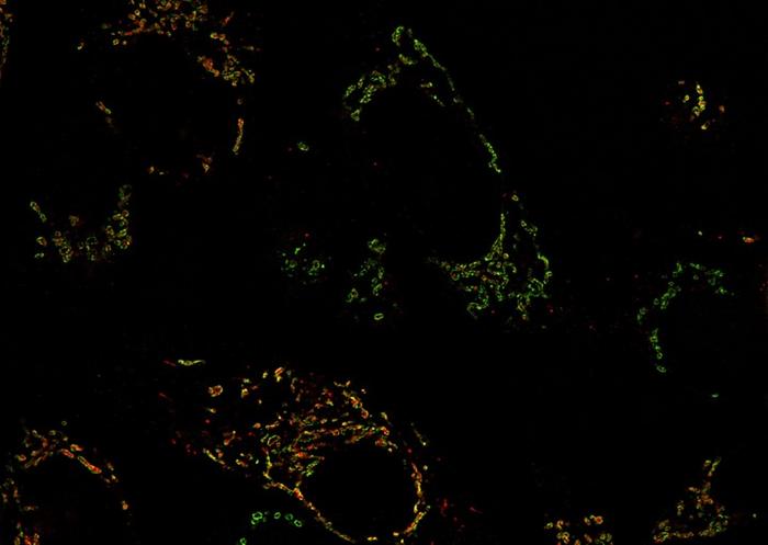 Microscopic image of a cancer cell