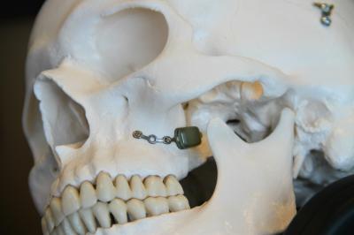 Doctors Implant Tiny, Experimental Neurostimulator to Treat Severe Headaches