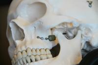 Doctors Implant Tiny, Experimental Neurostimulator to Treat Severe Headaches