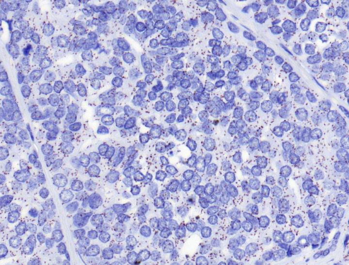 Unexpected Protein Modification Makes Prostate Cancer Invasive (2 of 2)