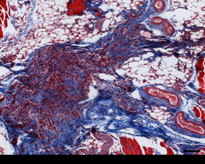 Study in Mice Uncovers An Unknown Pathway for Breast Cancer Tumors to Recur