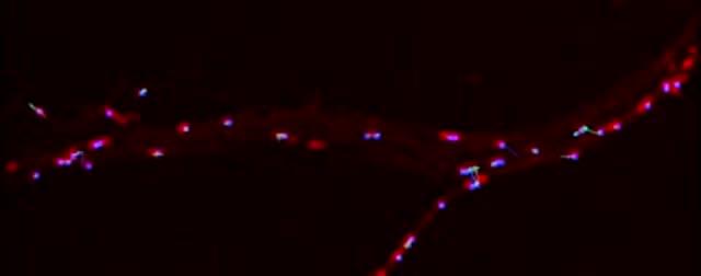Understanding Amyotrophic Lateral Sclerosis