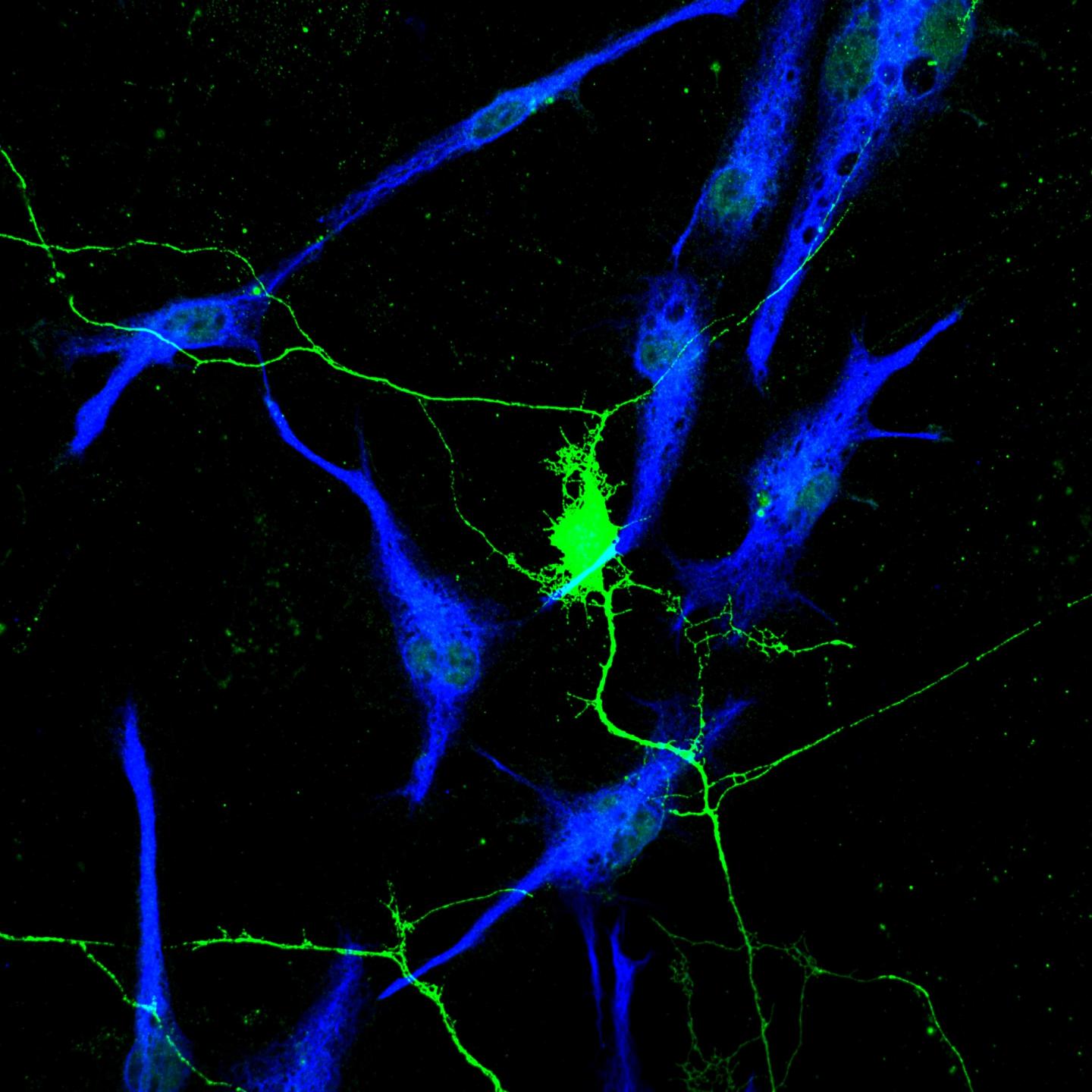 Neurons with Glioma Cells