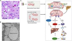 Megamitochondria and a proposed model of mitochondrial dynamics in regulating cell death, pyrimidine metabolism and mtDNA-mediated cGAS–STING innate immune responses in ALD and liver tumourigenesis.