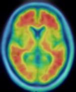 Pet Scan
