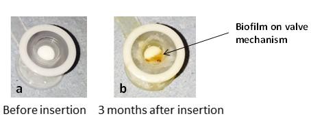 Voice Prosthesis Biofilm