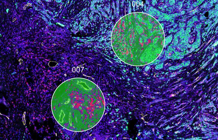 Breast cancer tissue