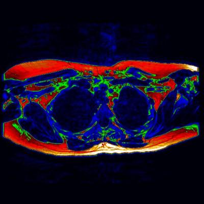MRI Showing Areas of Potential Brown Fat