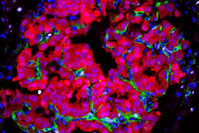 Tumor Cells Transform Their Local Environment