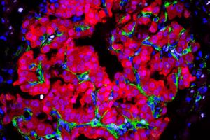 Tumor Cells Transform Their Local Environment
