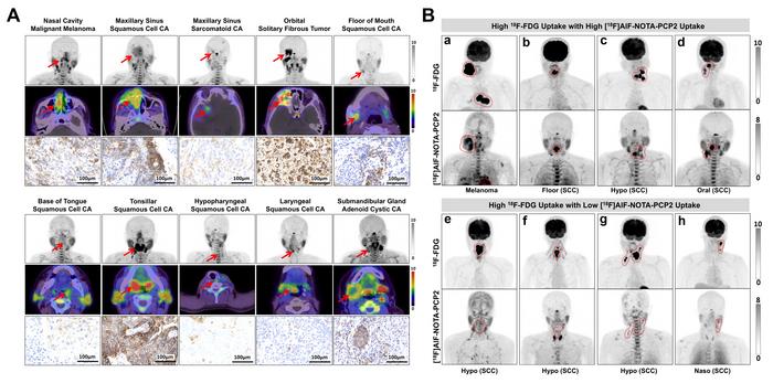 PD-L1 targeting molecular imaging in head and neck carcinoma: A head-to-head comparison of [18F]AlF-NOTA-PCP2 PET and [18F]FDG PET/CT.