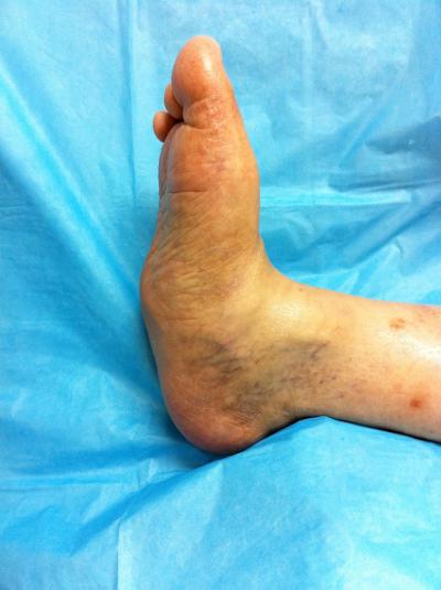 Charcot Foot