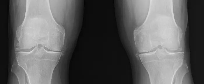 Potential to Prevent and Treat a Common Type of Inflammatory Arthritis Advanced by the Identification of New Genetic Links