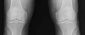 Potential to Prevent and Treat a Common Type of Inflammatory Arthritis Advanced by the Identification of New Genetic Links