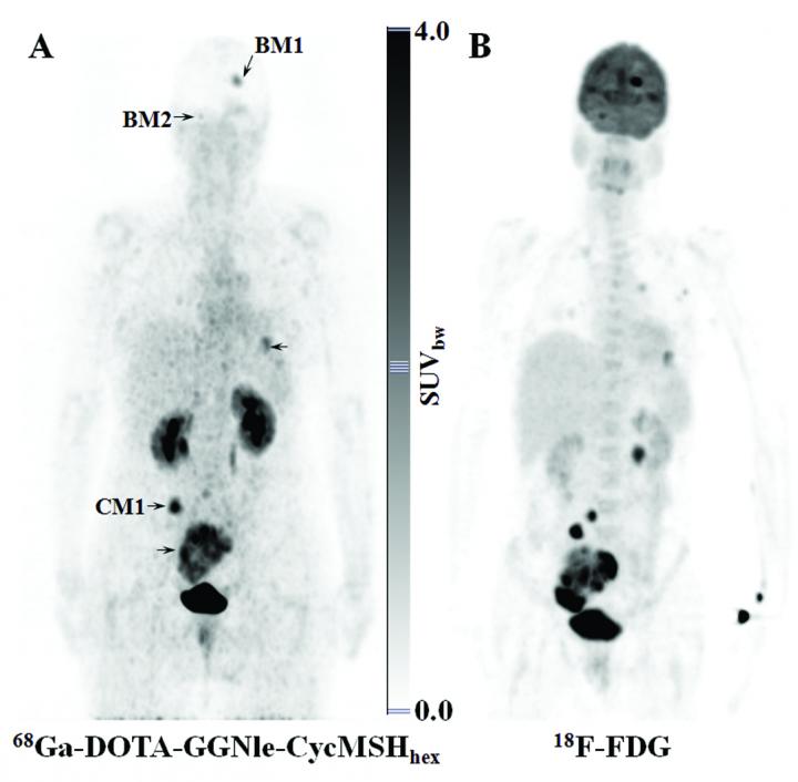 Imaging Probes Track Down Metastatic Melanoma Tumors (1 of 1)