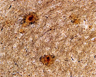 New Combination Drug Therapy for Alzheimer's (2 of 2)