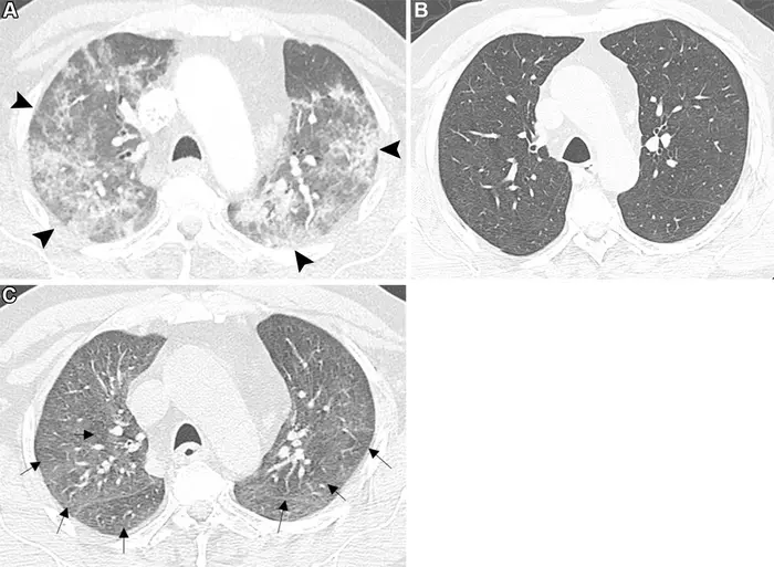 Axial chest CT images show air trapping following COVID-19 pneumonia in a 61-year-old male patient with persistent mild dyspnea at exertion with dry cough