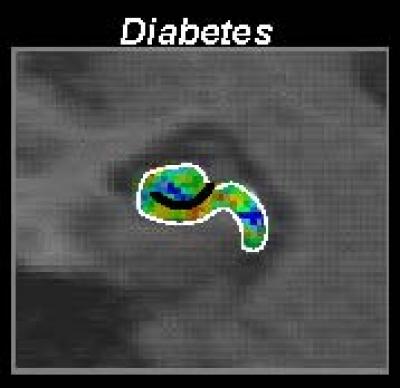 Diabetes