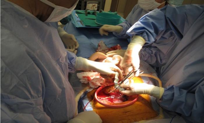 Umbilical Cord Blood as a Stem Cell Source