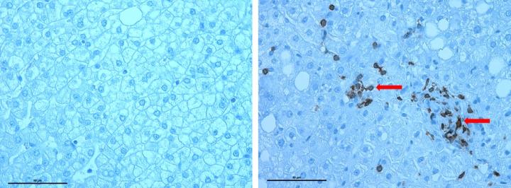Healthy Liver (left) and Diseased Liver (right) with Infiltrated CD8 T-cells Indicated by Arrow