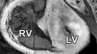 Hypoplastic Left Heart Syndrome (1 of 2)