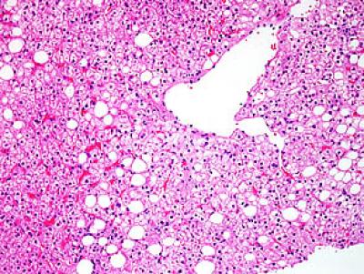 NAFLD No NASH