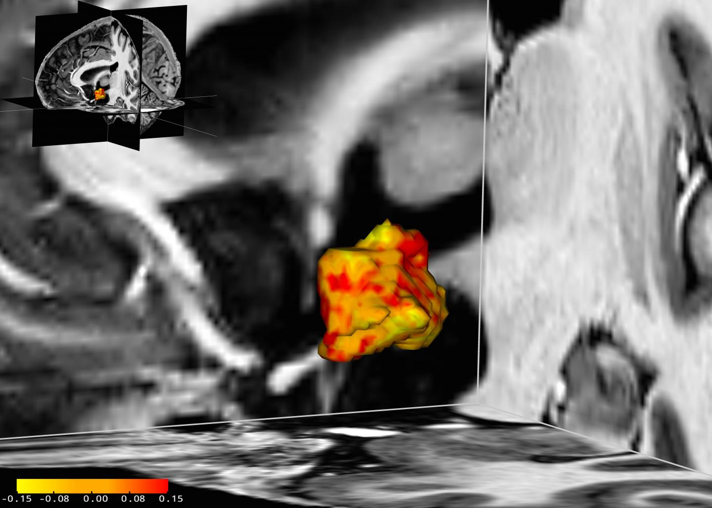 View of the Left Hypothalamus, in the Center of the Brain