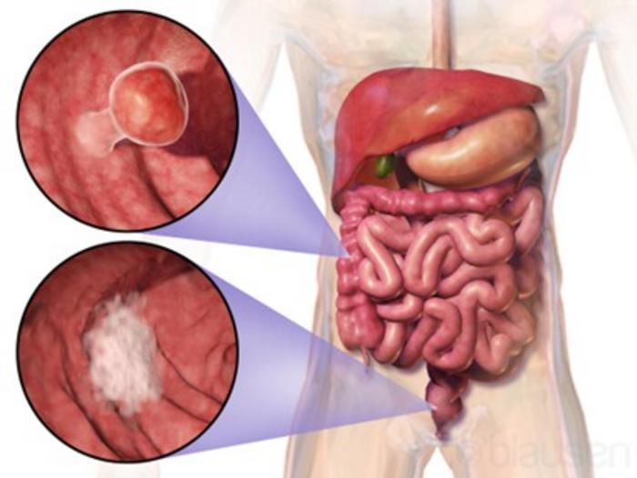 Gastrointestinal tract cancers