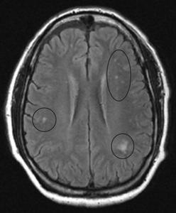 Magnetic resonance image showing lesions in the brain