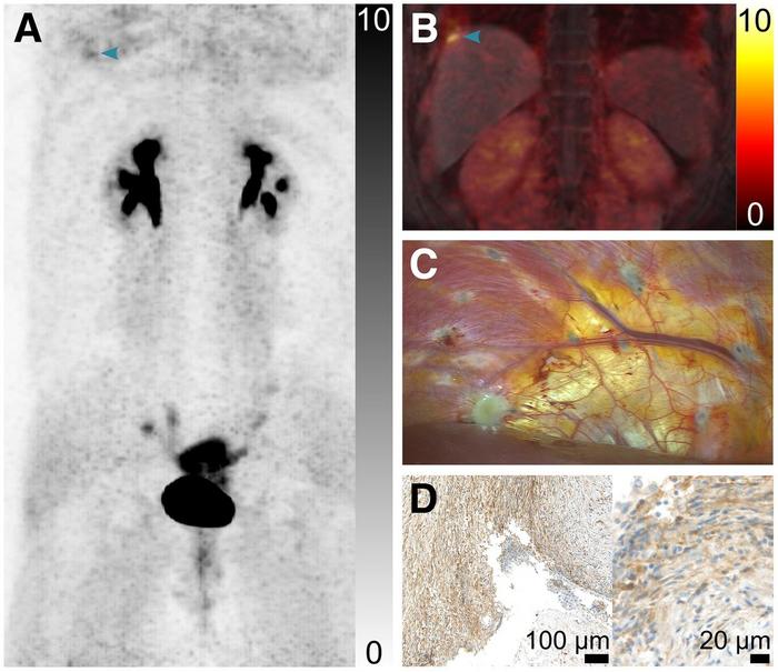 Images from a patient who had menstrual cycle–dependent right shoulder pain.