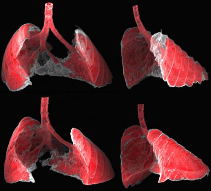 Lungs of a Mouse with Fibrosis