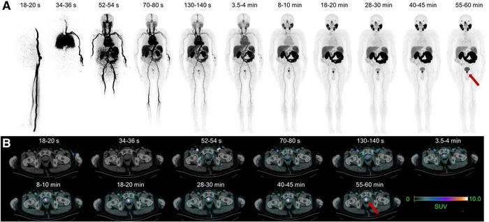 Dynamic total-body PSMA PET