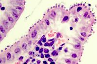Cryptosporidium infection